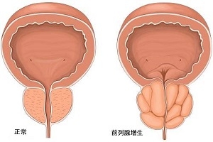 前列腺大是否一定有症状?前列腺大是前列腺增生吗?35 作者: 来源: 前列腺大是否一定有症状?前列腺大是前列腺增生吗?35 作者: 来源: